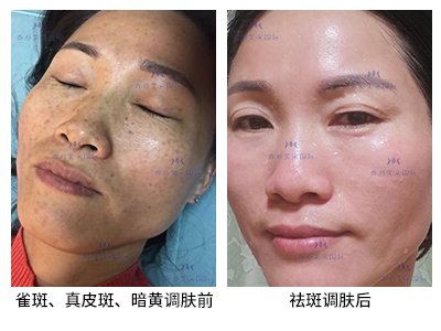 祛斑案例-美肤来（深圳）生物科技有限公司