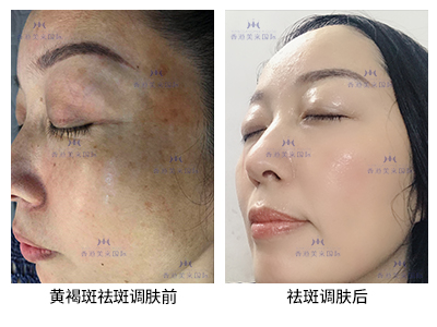 祛斑案例-美肤来（深圳）生物科技有限公司